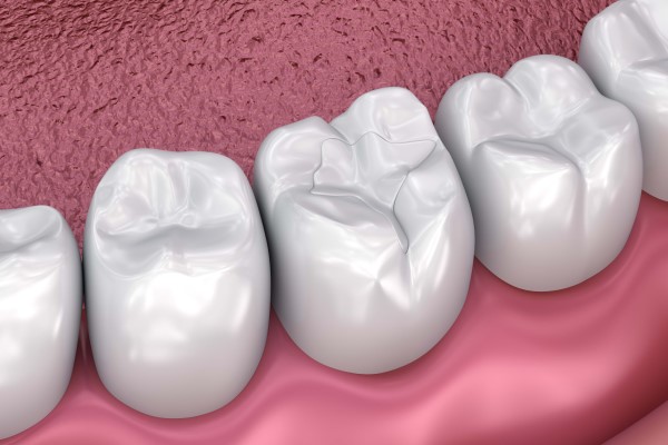 How A Dental Filling Can Treat Tooth Decay