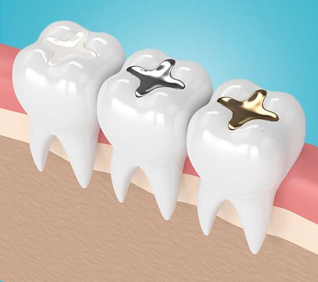 Cypress Composite Fillings