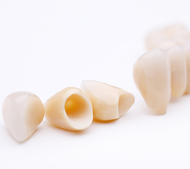 Cypress Dental Crowns and Dental Bridges