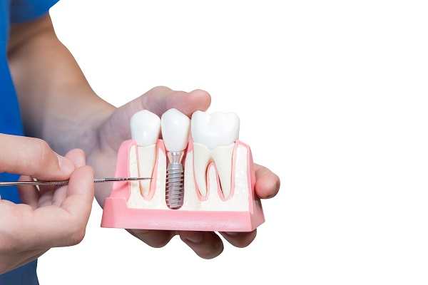 Can A General Dentist Repair A Dental Implant Restoration?