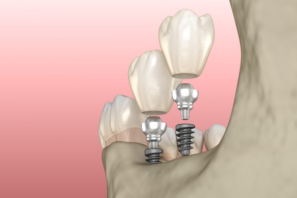 Asking Your Dentist If Dental Implants Are Right For You