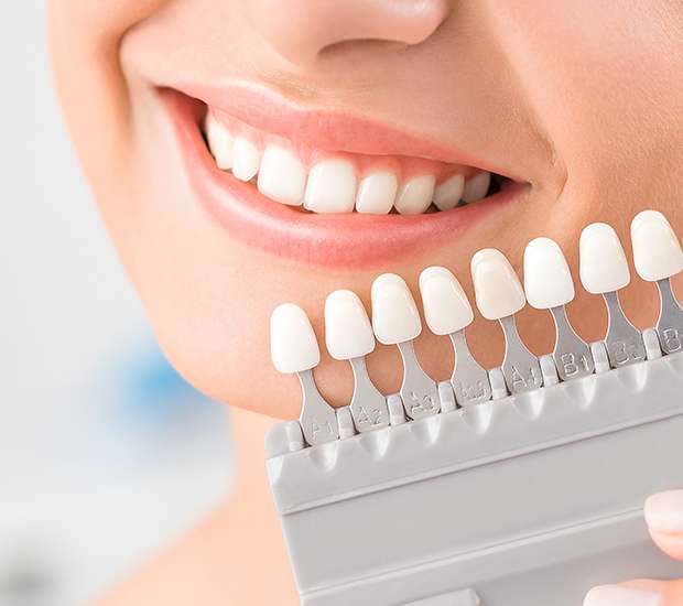 Cypress Dental Veneers and Dental Laminates
