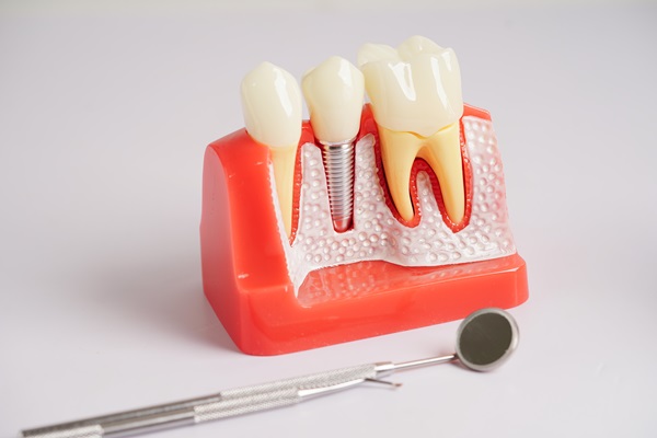 Dental Implant Crown Placement FAQs